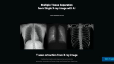 TiSepX x-ray quantitative analysis and tissue separation solution by Medical IP