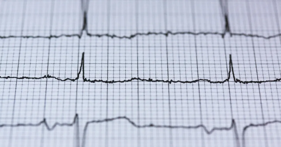 An EKG readout