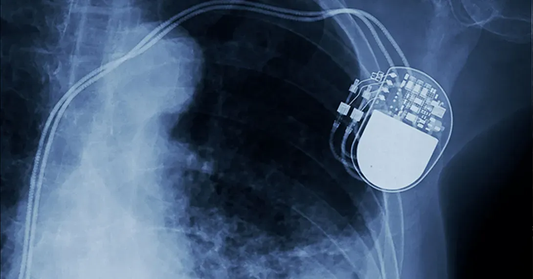 Cardiac implant shows on a medical image