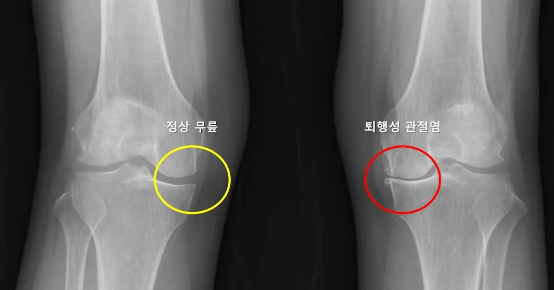A knee X-ray image showing the difference between healthy and arthritic knees